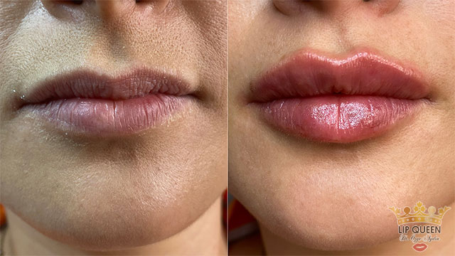 lip queen dudak dolgusu ankara doktor özge aydın