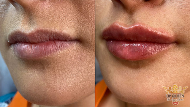 lip queen dudak dolgusu ankara doktor özge aydın