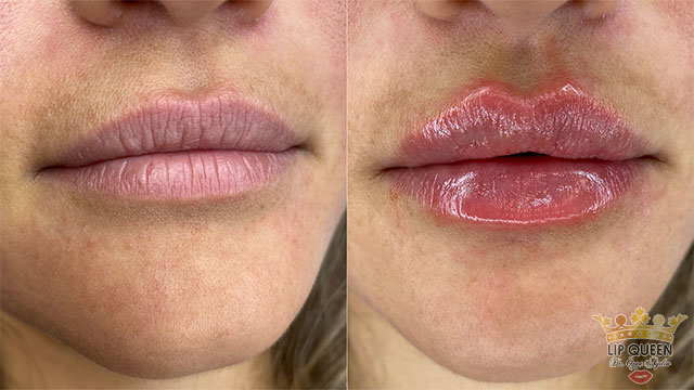 lip queen dudak dolgusu ankara doktor özge aydın