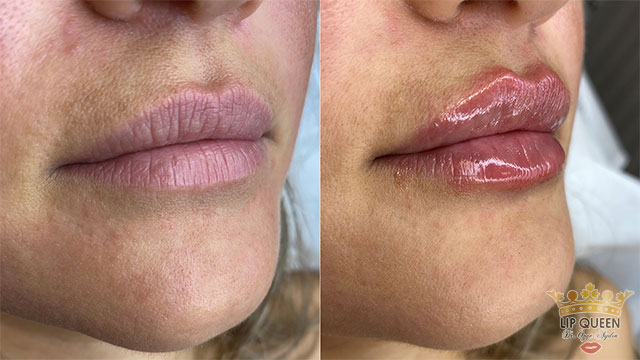 lip queen dudak dolgusu ankara doktor özge aydın