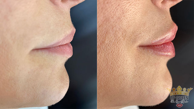 lip queen dudak dolgusu ankara doktor özge aydın