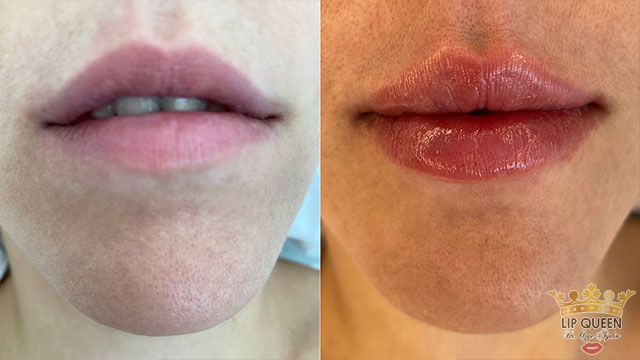 lip queen dudak dolgusu ankara doktor özge aydın
