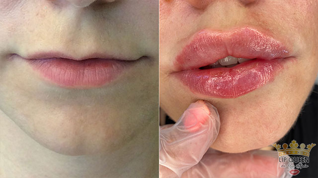 lip queen dudak dolgusu ankara doktor özge aydın