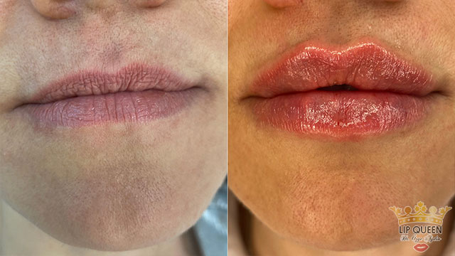 lip queen dudak dolgusu ankara doktor özge aydın