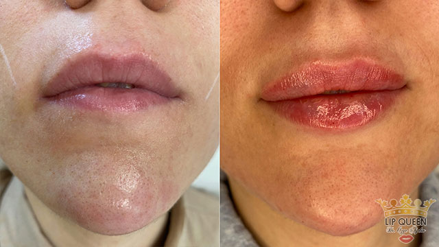 lip queen dudak dolgusu ankara doktor özge aydın