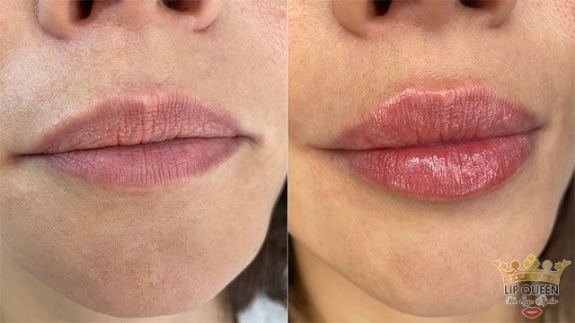 lip queen dudak dolgusu ankara doktor özge aydın