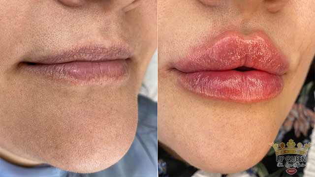 lip queen dudak dolgusu ankara doktor özge aydın