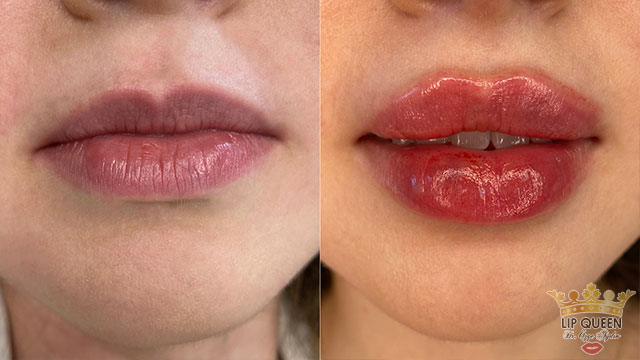 lip queen dudak dolgusu ankara doktor özge aydın