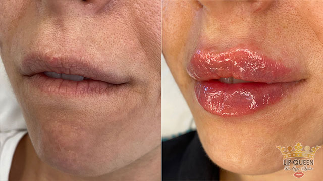 lip queen dudak dolgusu ankara doktor özge aydın