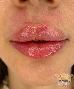 lip queen dudak dolgusu ankara doktor özge aydın
