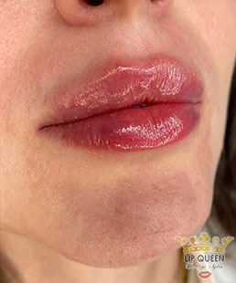 lip queen dudak dolgusu ankara doktor özge aydın