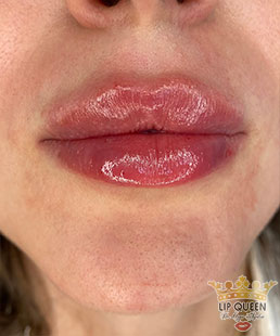 lip queen dudak dolgusu ankara doktor özge aydın