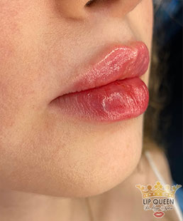 lip queen dudak dolgusu ankara doktor özge aydın