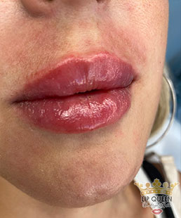 lip queen dudak dolgusu ankara doktor özge aydın