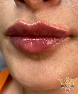 lip queen dudak dolgusu ankara doktor özge aydın