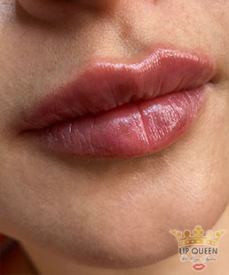 lip queen dudak dolgusu ankara doktor özge aydın